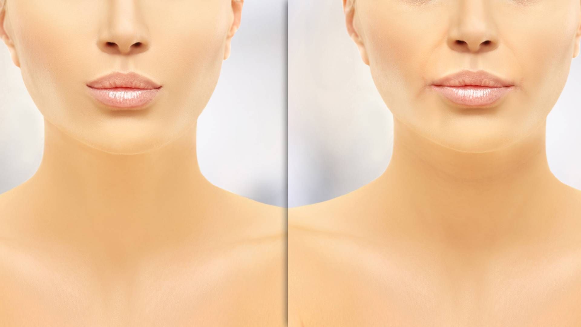 A woman’s face with Restylane Before and After near Lexington, London, Richmond, and Paris, Kentucky