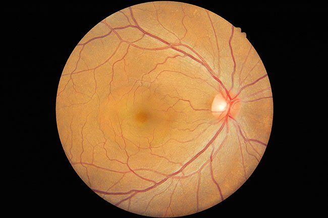 Retina - Clear Optometry In Bargara, QLD