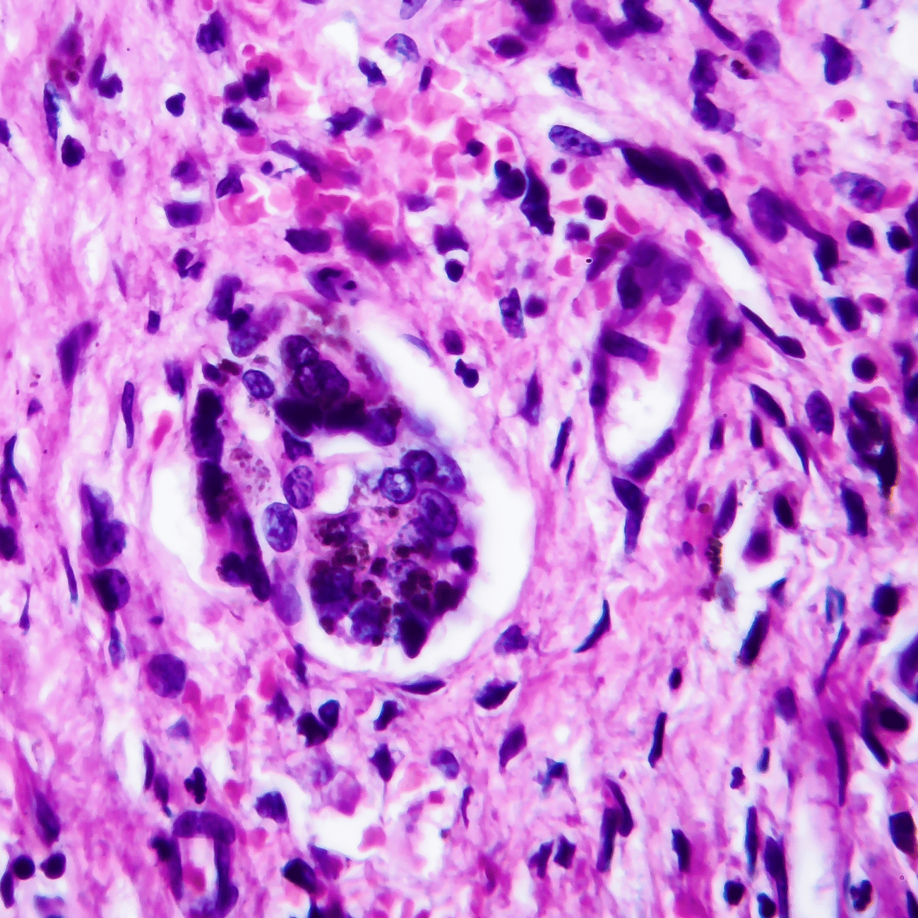 Melanoma under a microscope