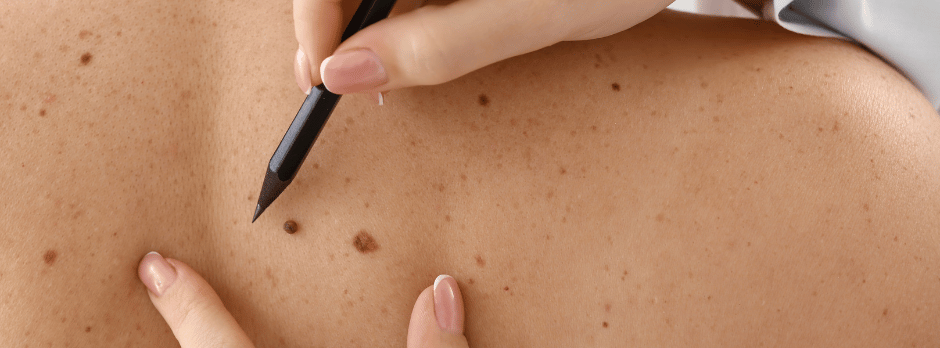 A person is drawing a spot on a person 's back with a pen.