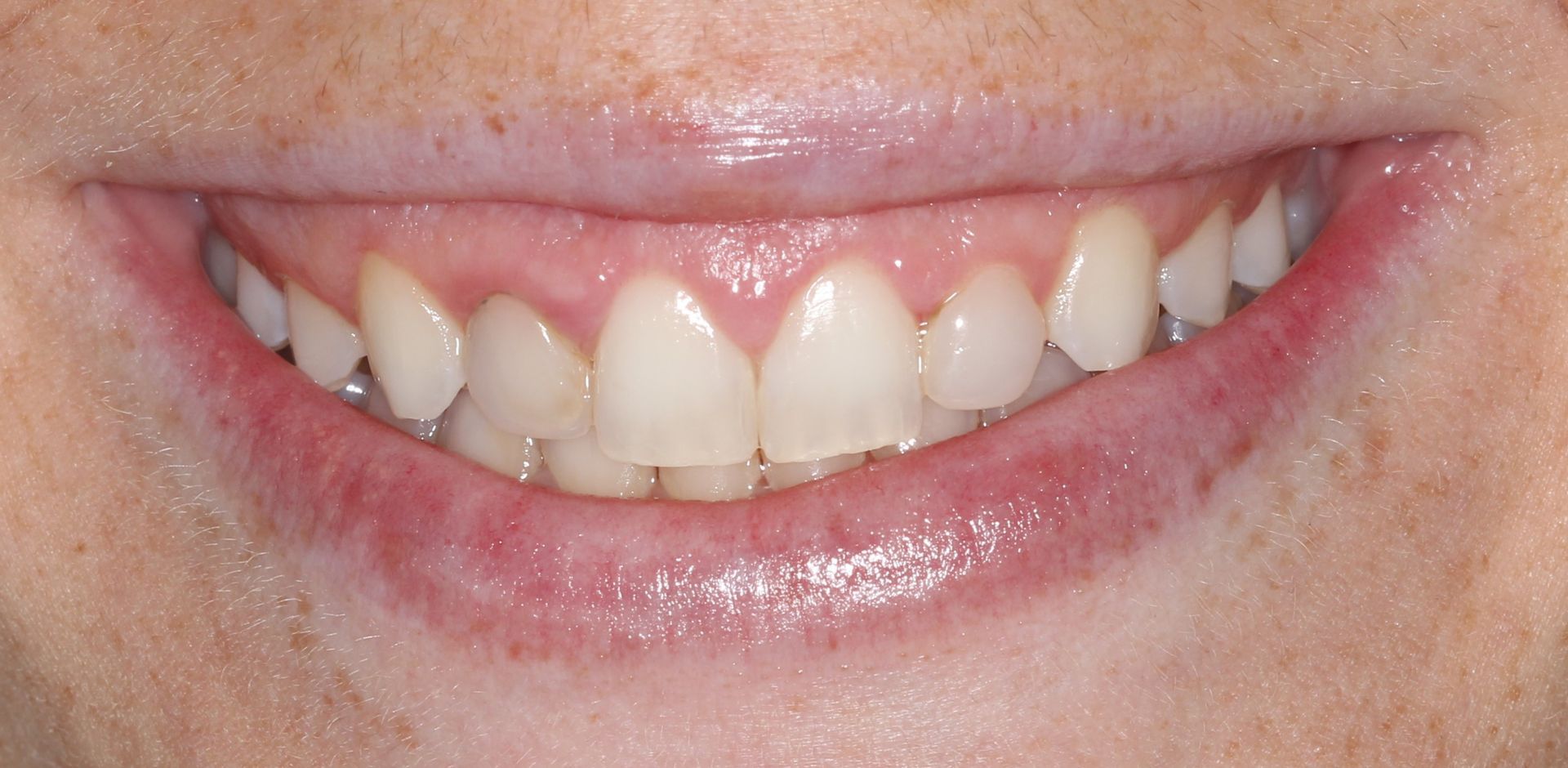 A close up of a person 's teeth with a needle sticking out of it.