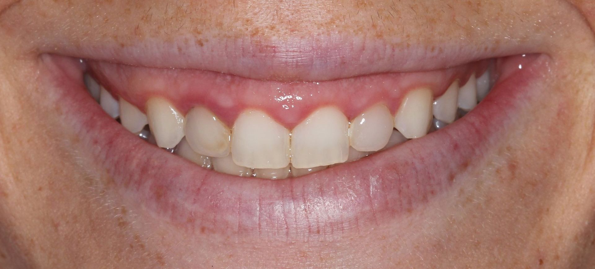 A close up of a person 's mouth with white teeth and red gums.