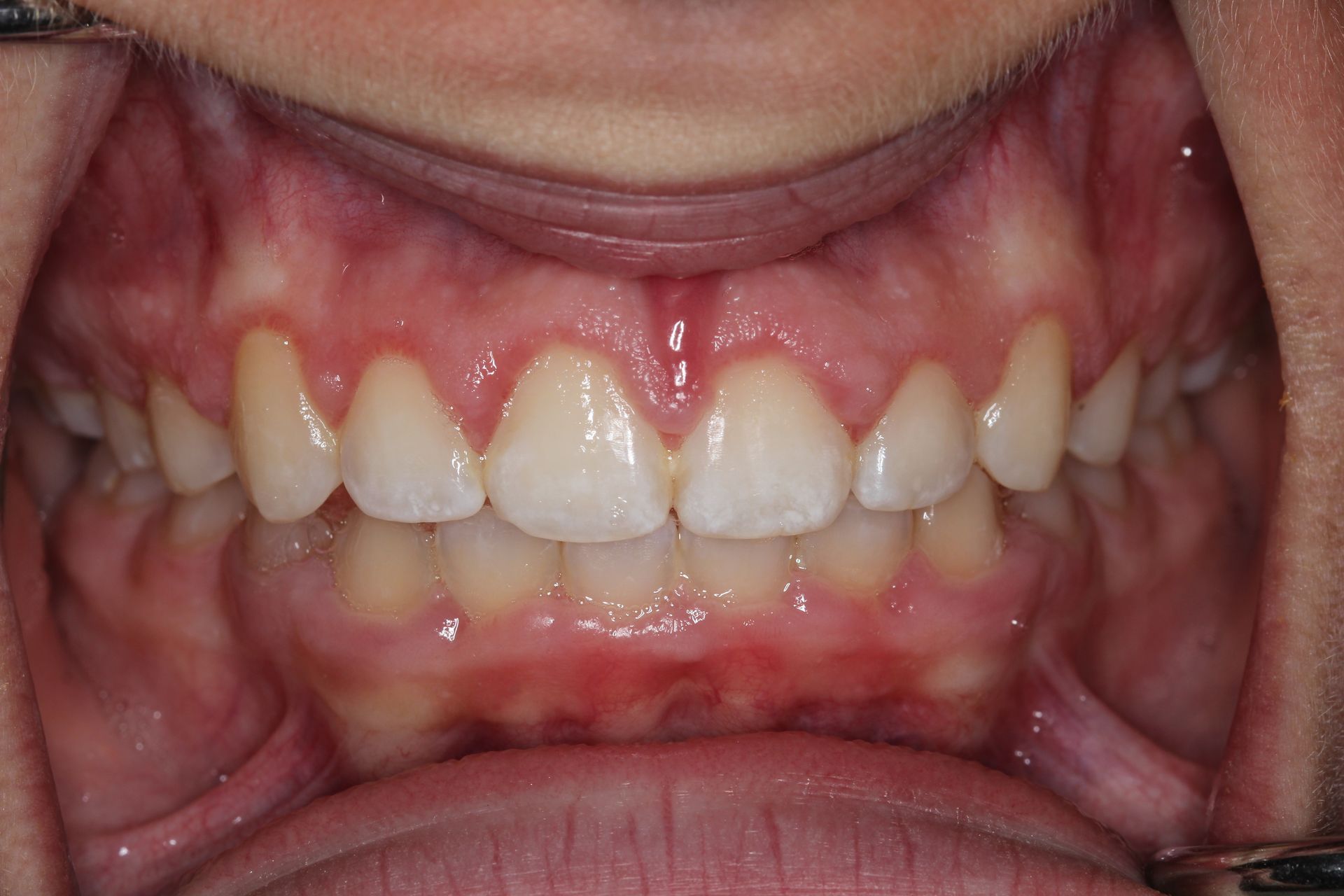 A close up of a person 's mouth with white teeth and red gums.