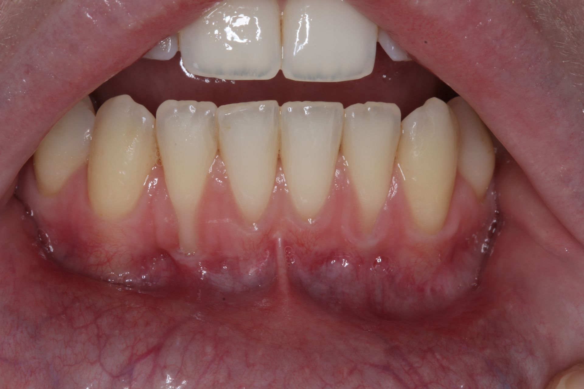 A close up of a person 's mouth with white teeth and red gums.