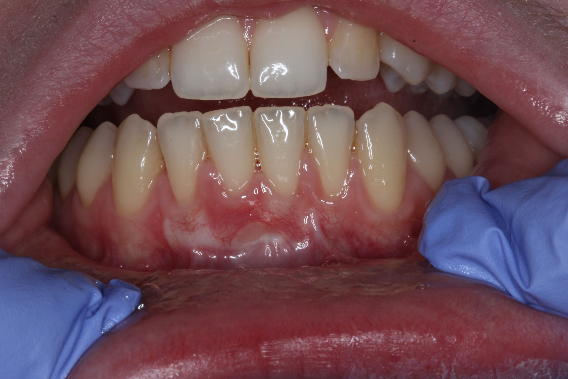 A close up of a person 's teeth with a needle sticking out of it.