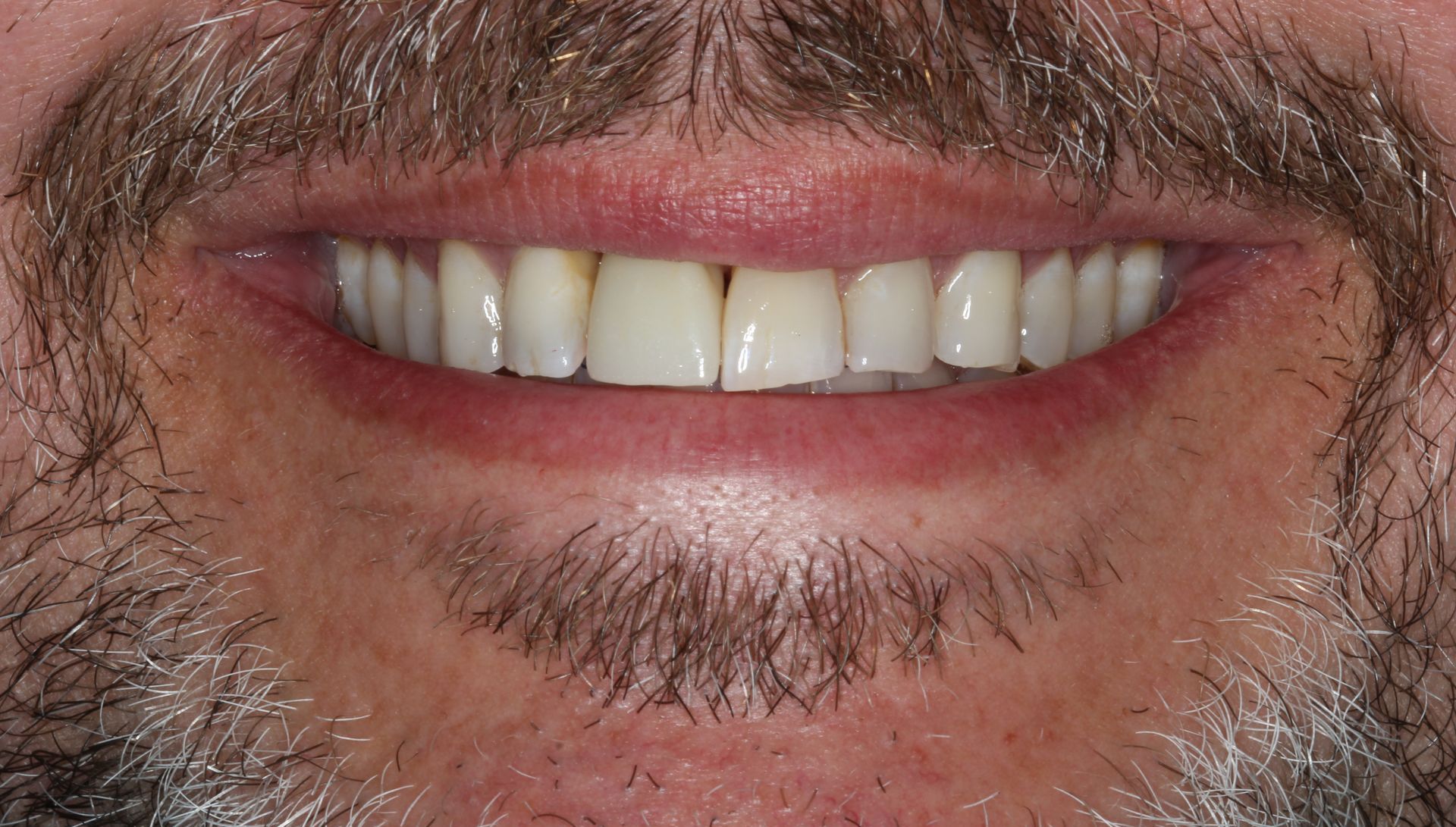 A close up of a person 's teeth with blue gloves on.