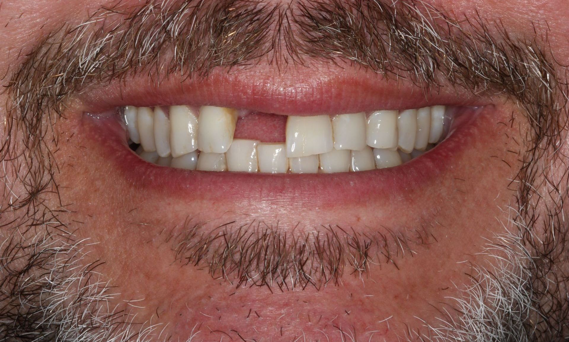 A close up of a person 's mouth with white teeth and red gums.