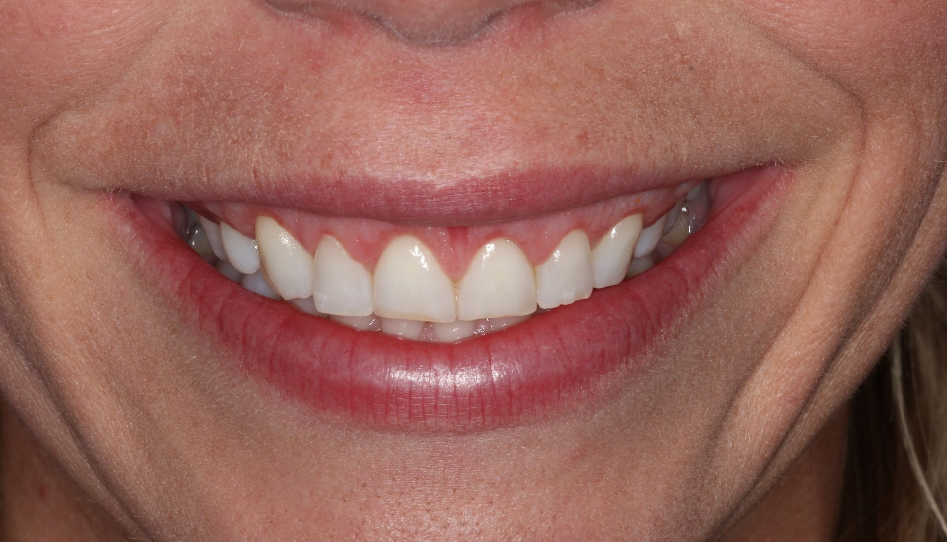 A close up of a person 's mouth with white teeth and red gums.