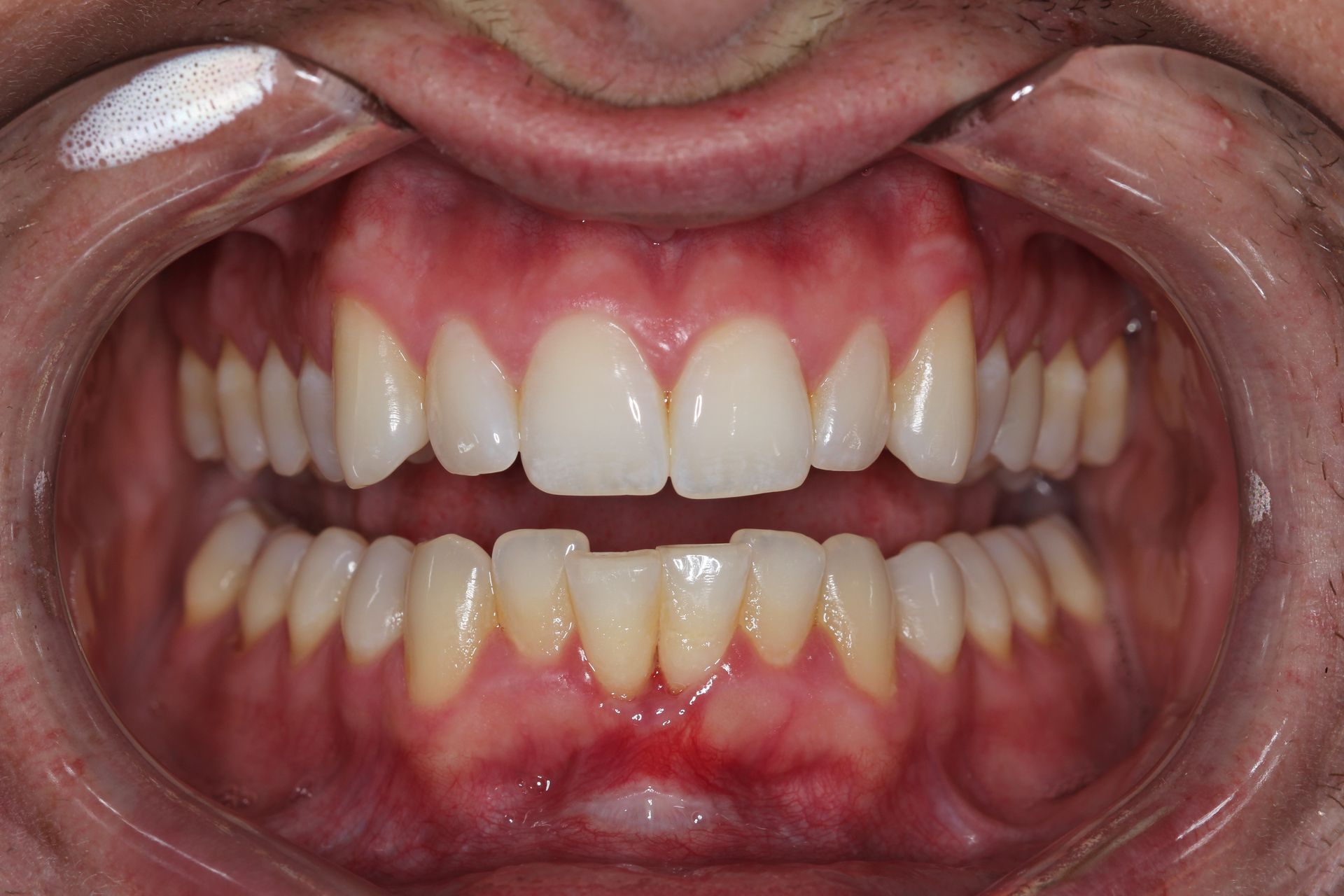 A close up of a person 's teeth with a needle sticking out of it.