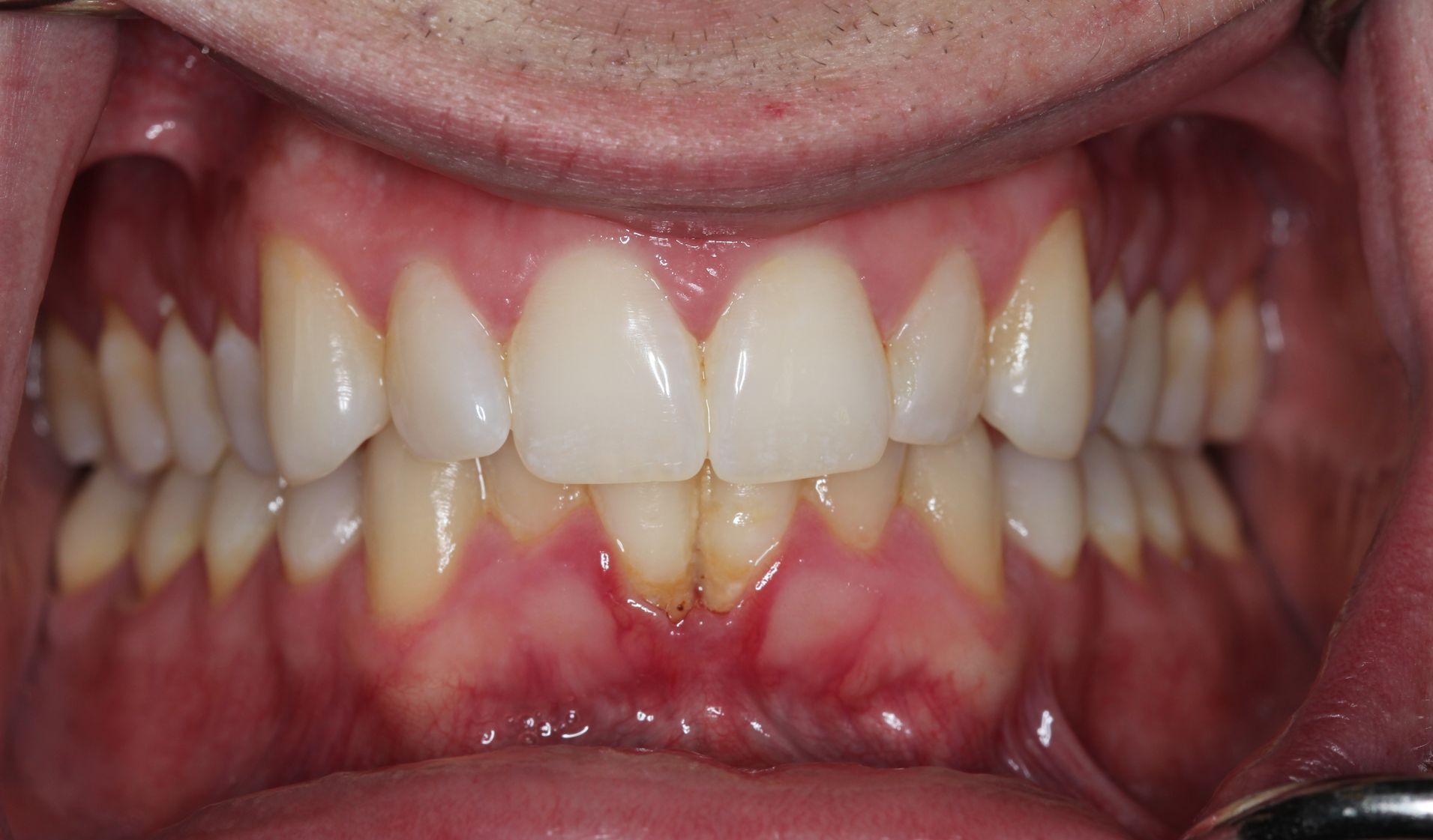 A close up of a person 's mouth with white teeth and red gums.