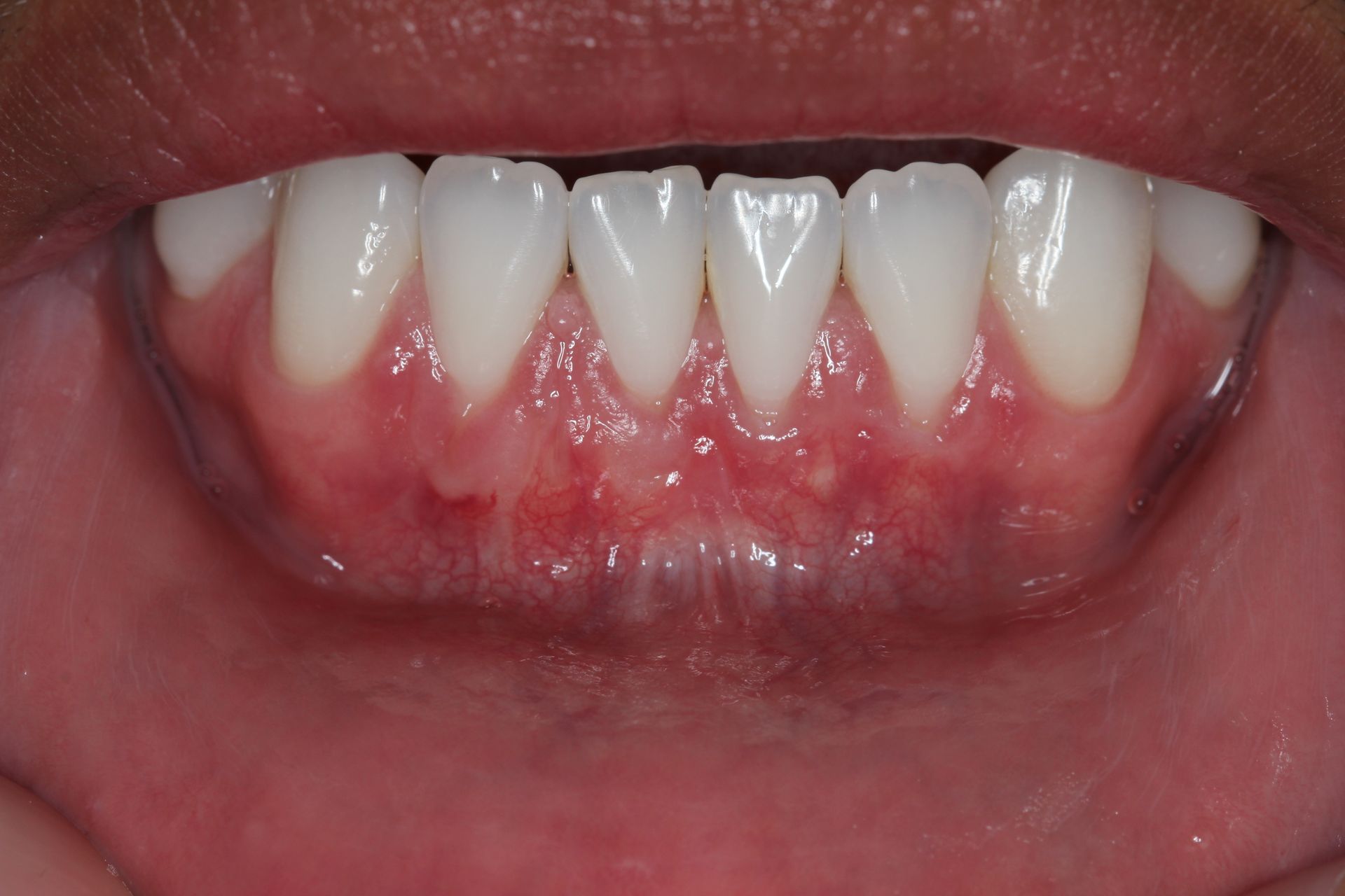 A close up of a person 's teeth with blue gloves on.