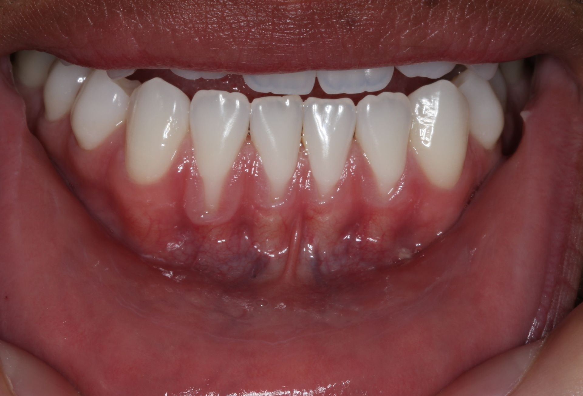 A close up of a person 's mouth with white teeth and red gums.