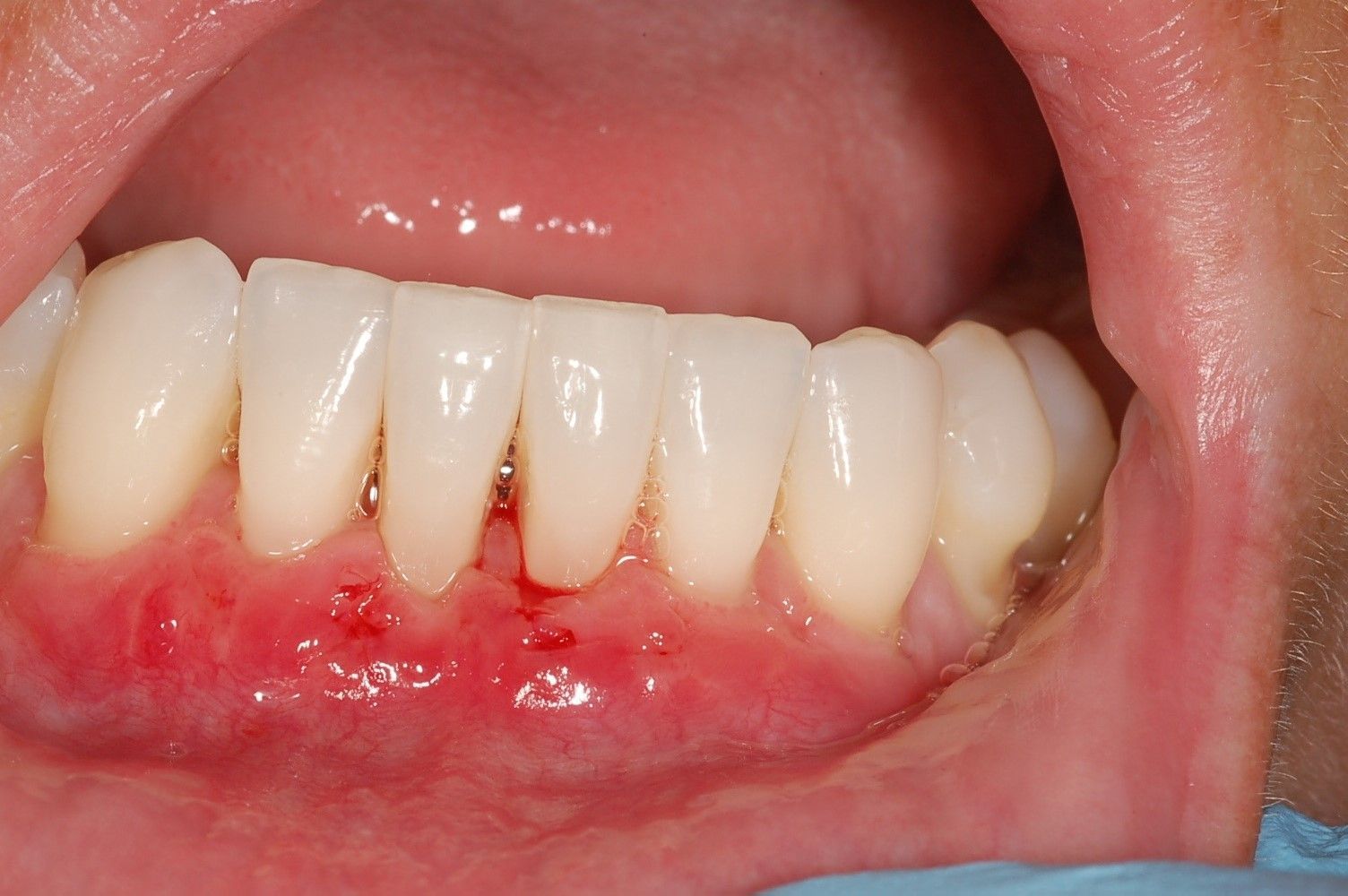 A close up of a person 's teeth with blue gloves on.