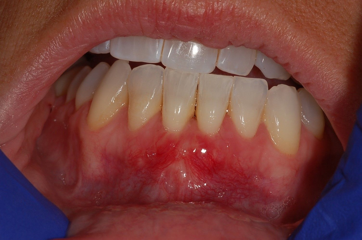 A close up of a person 's mouth with white teeth and red gums.