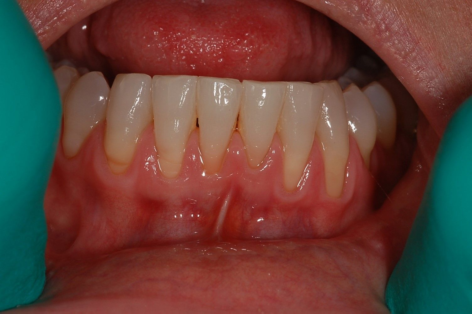 A close up of a person 's mouth with white teeth and red gums.