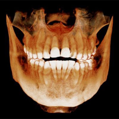 TOMOGRAFIA DENTAL