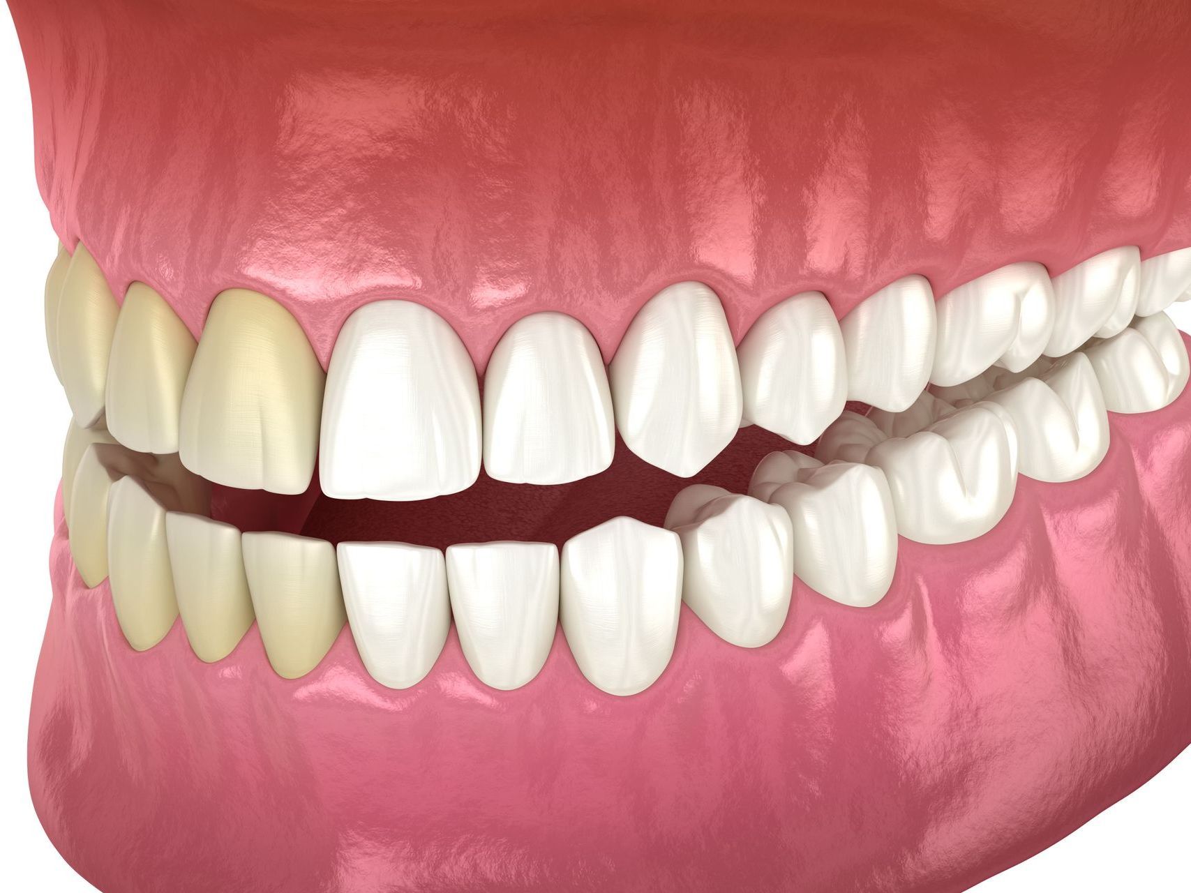 A computer generated image of teeth before and after whitening treatment