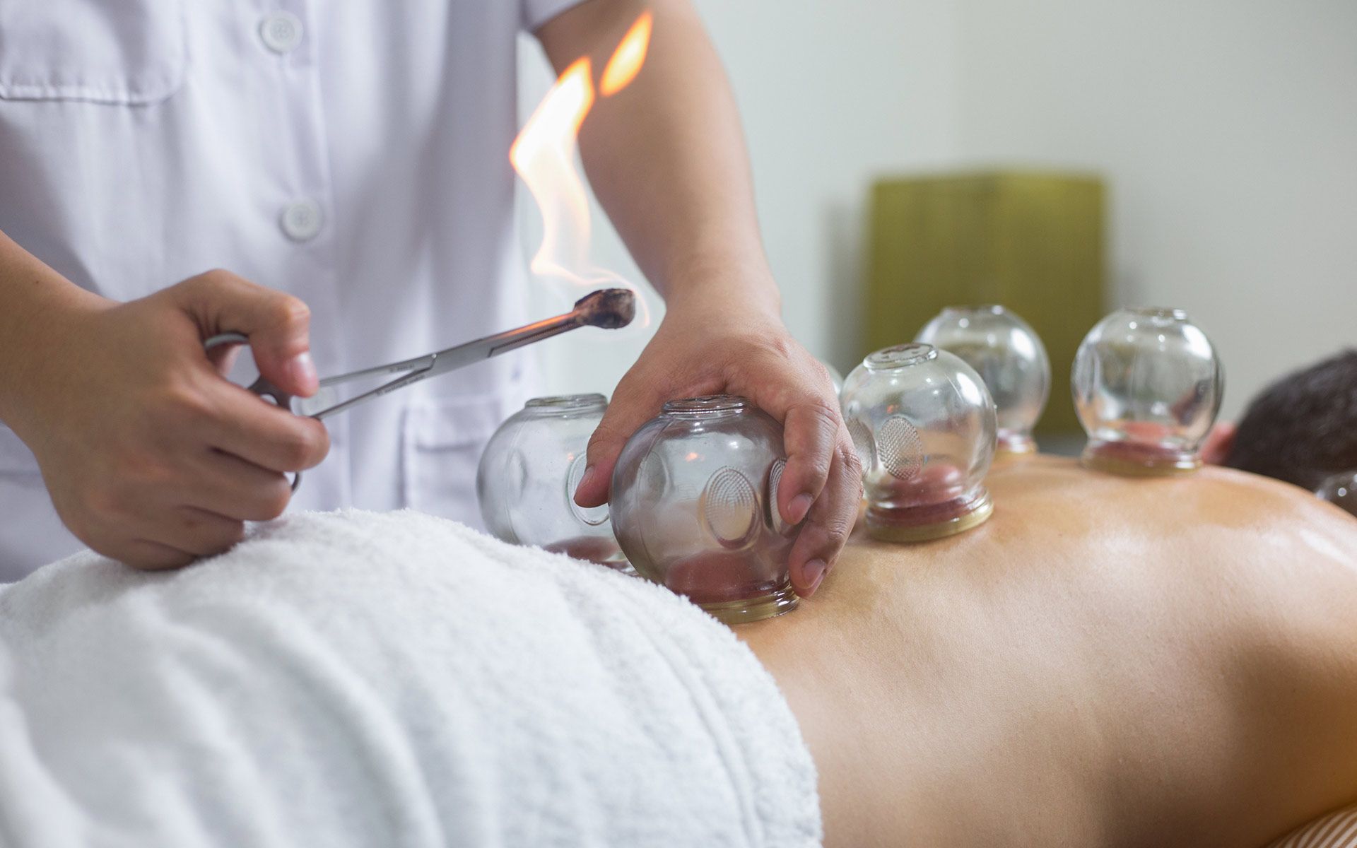 Cupping Therapy — Lafayette, LA — Shift Acupuncture And Wellness