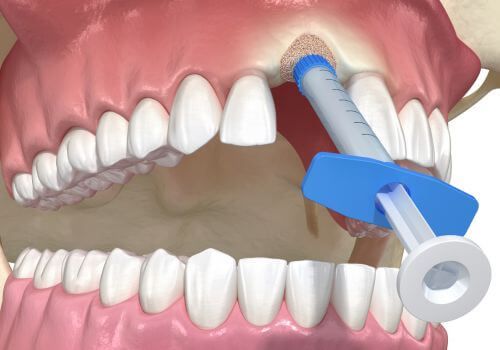 Dental implant being placed into the upper jaw with a blue surgical guide