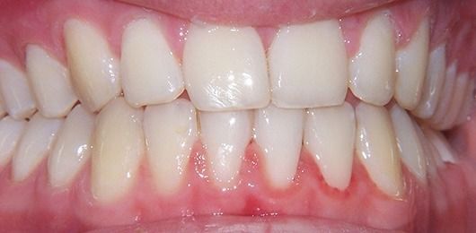 Close-up of a mouth showing white upper and lower teeth with pink gums