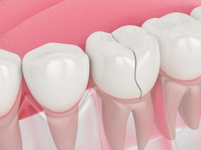 Close-up of teeth and gums with a cracked tooth against a pink background