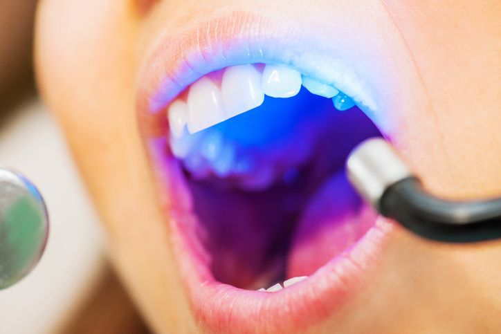 Close-up of a mouth receiving a blue light dental treatment during a checkup
