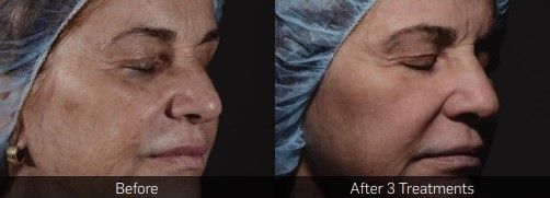 A before and after photo of a woman 's face wearing a surgical cap.