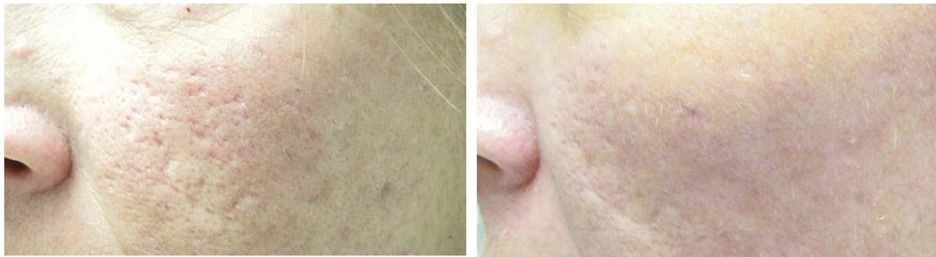A before and after photo of a woman 's face with acne.