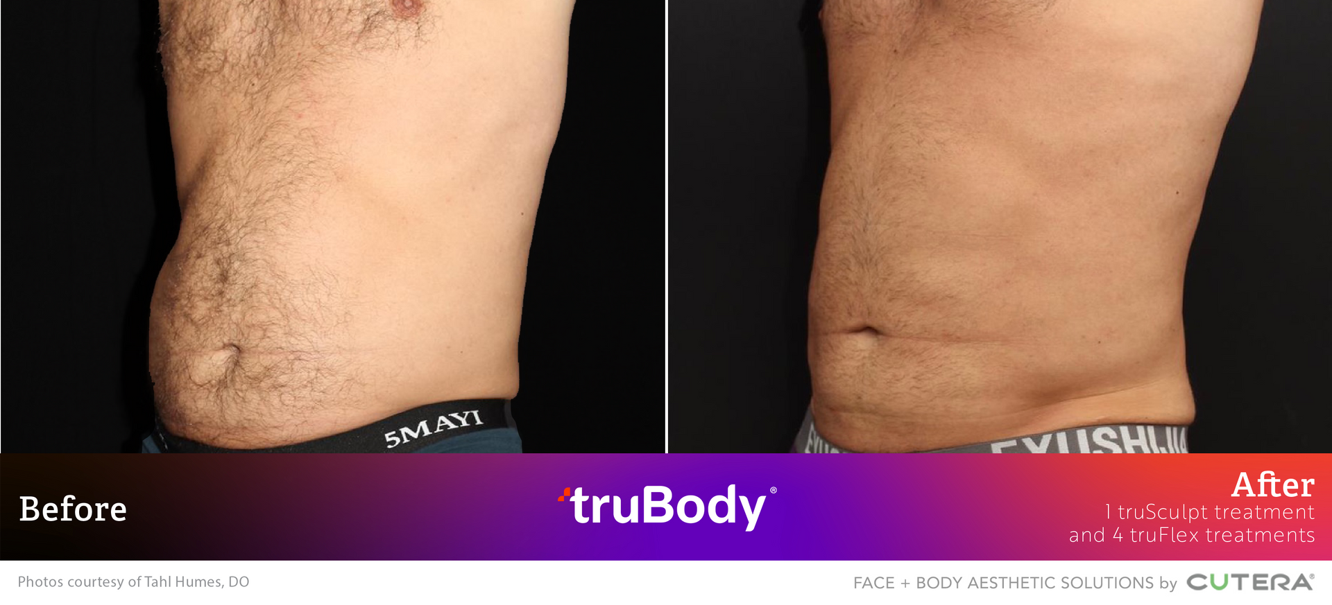A before and after photo of a man 's stomach.