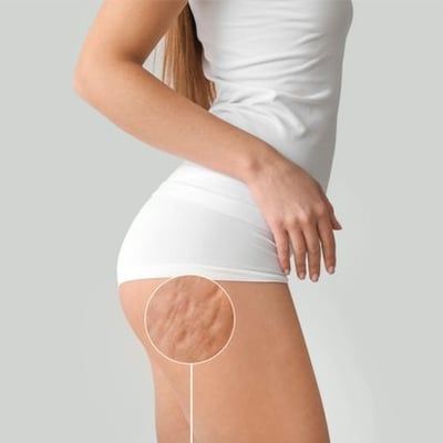 Cellulite — Urbandale, IA — Greater Des Moines Dermatology