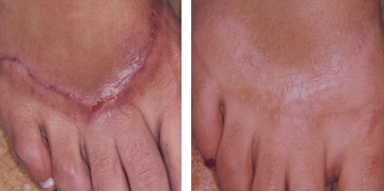 A before and after photo of a person 's foot and hand.