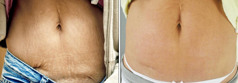 A before and after picture of a woman 's stomach with stretch marks.
