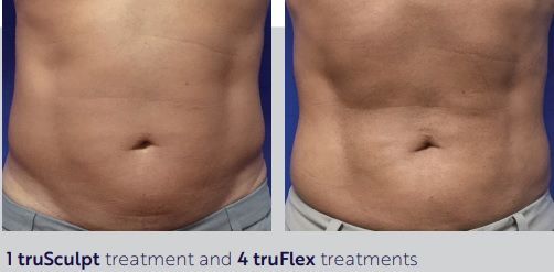 A before and after picture of a man 's stomach.