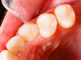 Metallfreie Füllungen aus Komposit oder Keramik: Nicht zu sehen wegen farblich perfekter Anpassung an die Zähne
