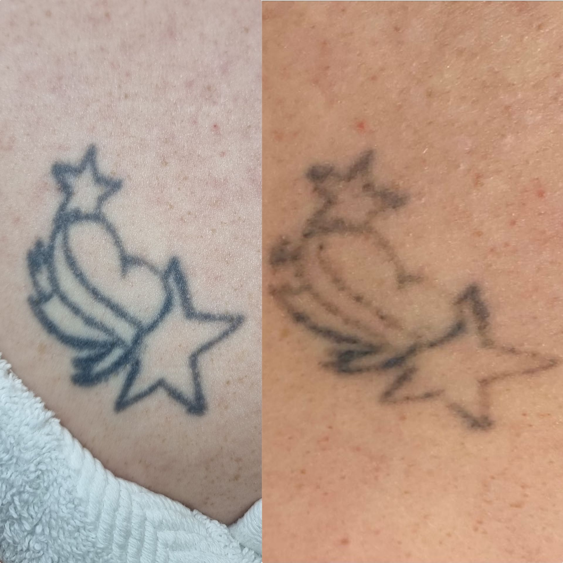 Tattoo removal on the wrist — Shepparton Skin & Body