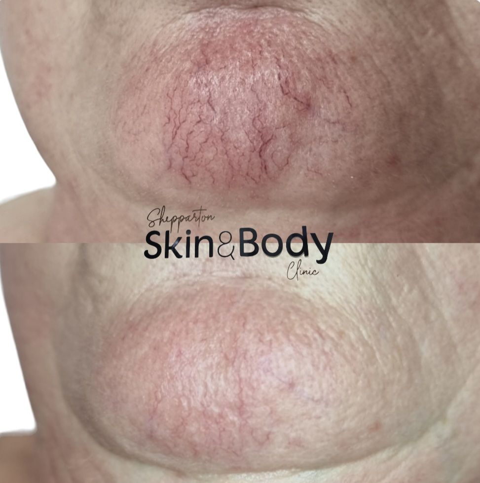 Before and after photo of a chin getting a vascular treatment — Shepparton Skin & Body