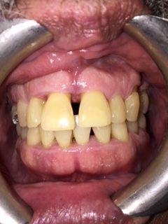 A close up of a person 's teeth before a dental treatment.