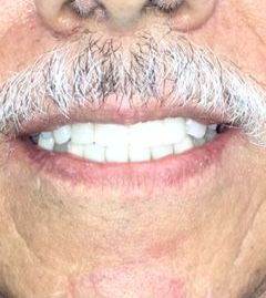 A close up of a person 's teeth with the caption after