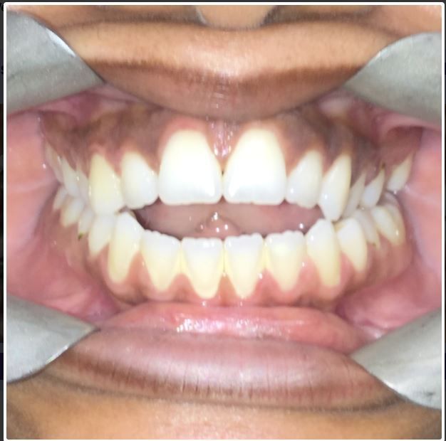A close up of a person 's mouth with broken teeth.