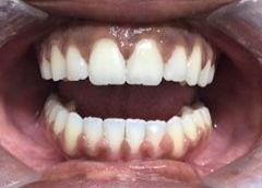 A close up of a person 's teeth after dental treatment.