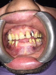 A close up of a person 's mouth with the words before below it