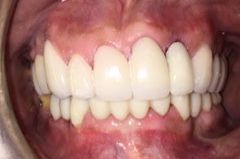 A close up of a woman 's teeth with the words after below it