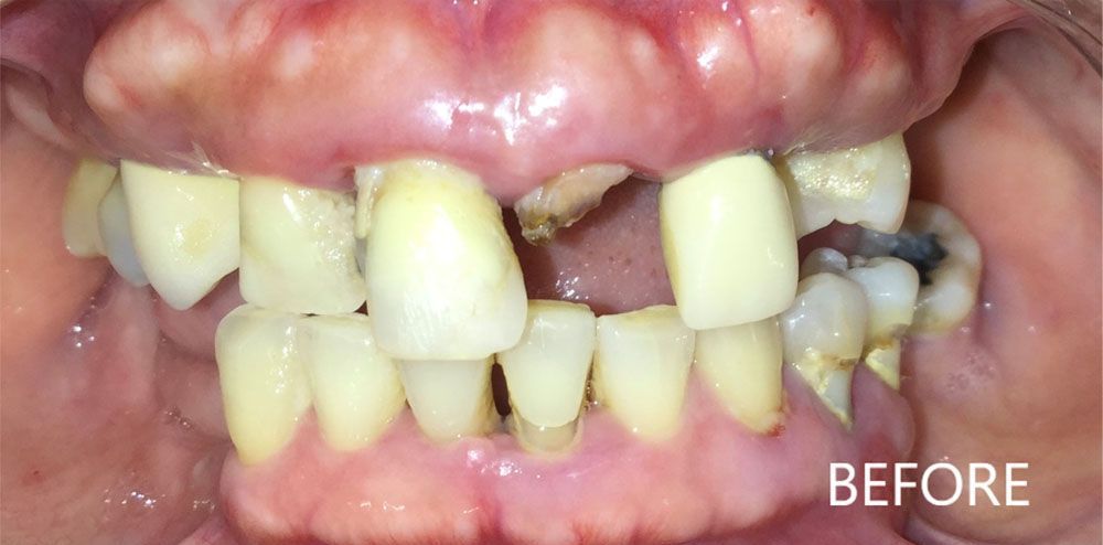 A close up of a person 's teeth before a dental treatment.