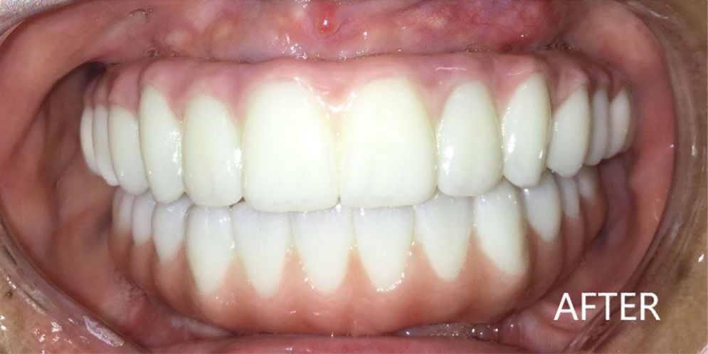 A close up of a person 's teeth with the caption after
