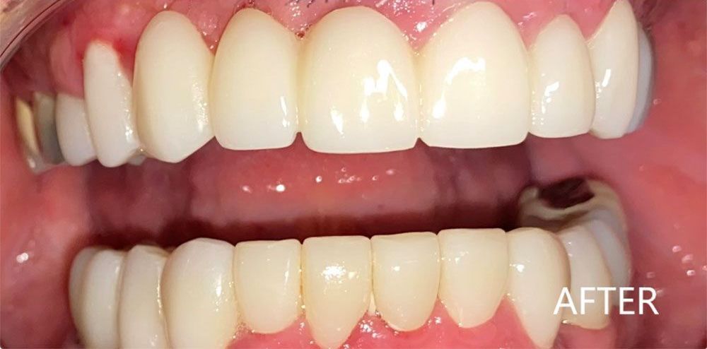 A close up of a person 's teeth after dental treatment.