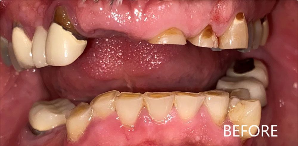 A close up of a person 's mouth with broken teeth.