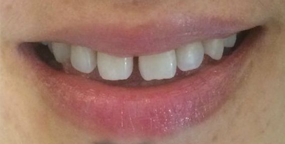 A close up of a person 's mouth with the words before below it