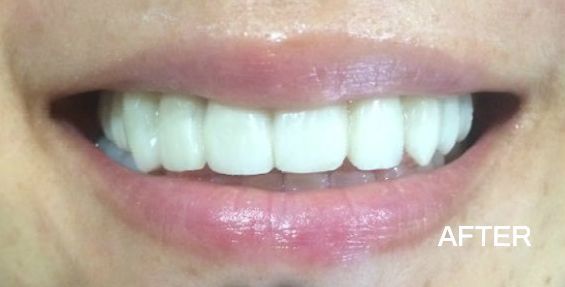 A close up of a woman 's teeth with the words after below it