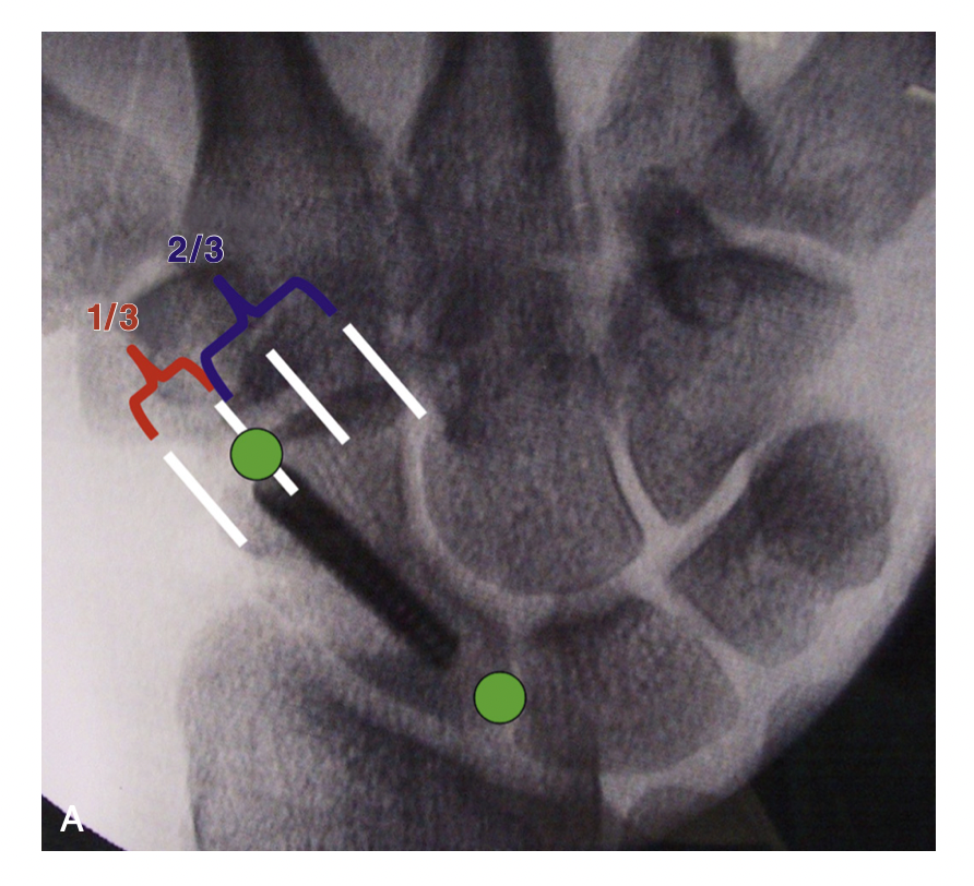 Um dos parâmetros utilizados pelo cirurgião para avaliar o posicionamento adequado do parafuso