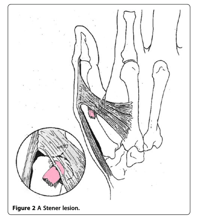 Stener Ladder Reparo Do Ligamento Colateral Ulnar Do Polegar Reparo De Ruptura Do